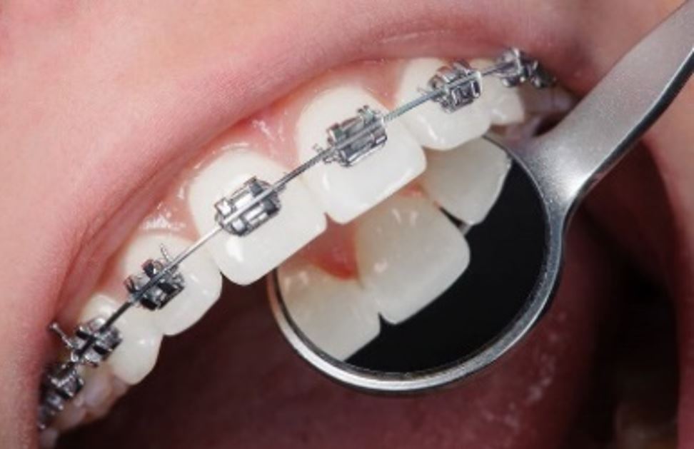 Close-up of traditional metal braces on teeth with a dental mirror reflecting the brackets.